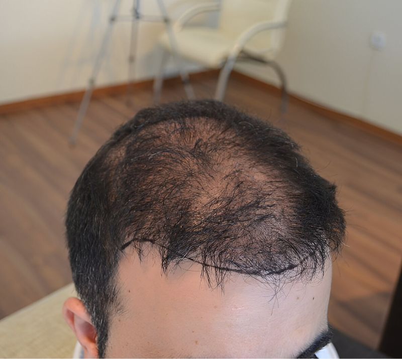 Hair Transplant And Restoration Services in Grande Prairie