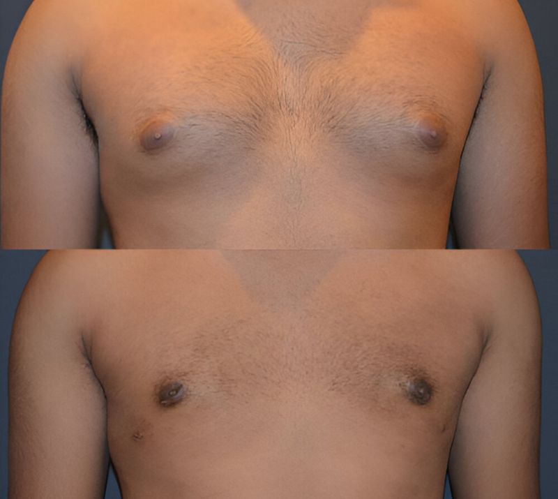 Male Breast Reduction In Airdrie