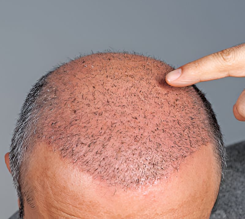 Hair Transplant And Restoration Services in Medicine Hat